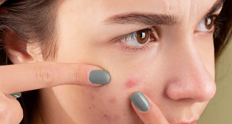 6 Stratégies pour combattre les causes profondes de l’acné